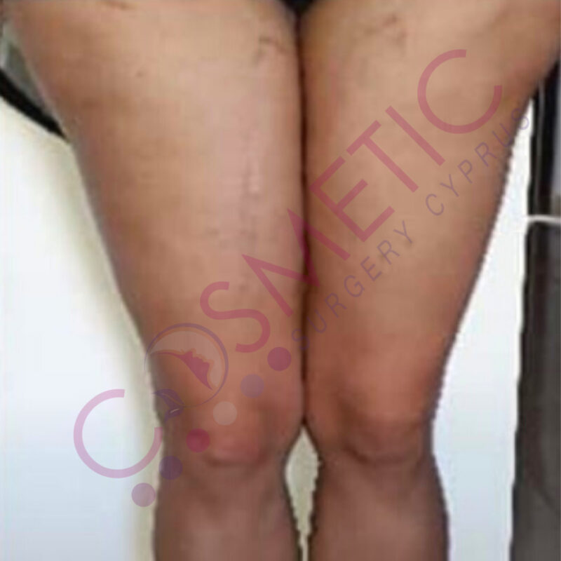 Thigh Lift Cosmetic Surgery Abroad
