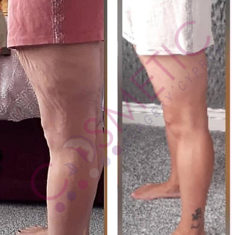 Thigh Lift Cosmetic Surgery Abroad