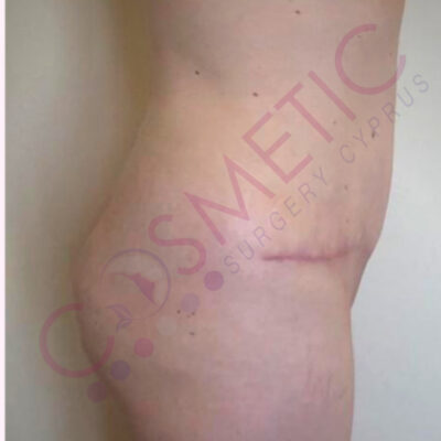 tummy tuck cosmetic surgery abroad