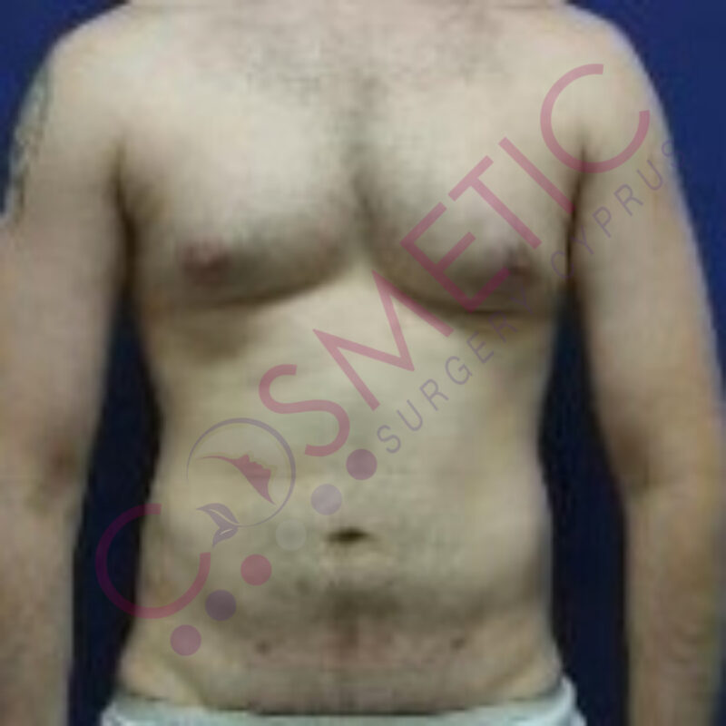 Liposuction Male Cosmetic Surgery abroad