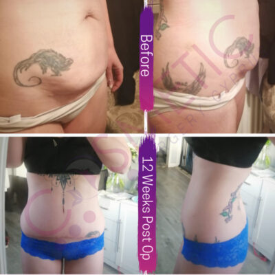 tummy tuck cosmetic surgery abroad
