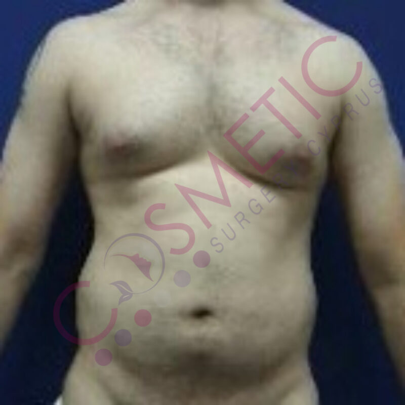 Liposuction Male Cosmetic Surgery abroad