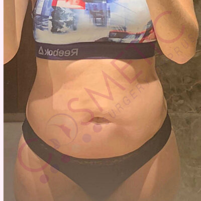 tummy tuck cosmetic surgery abroad