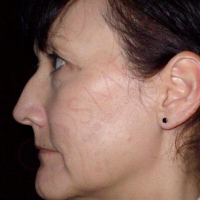 rhinoplasty nose job cosmetic surgery abroad