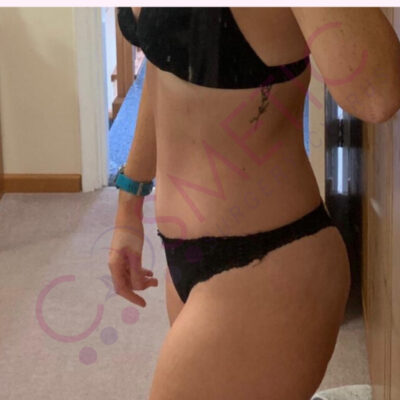 tummy tuck cosmetic surgery abroad