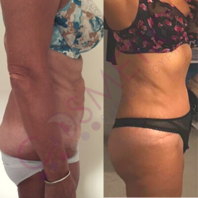 tummy tuck cosmetic surgery abroad