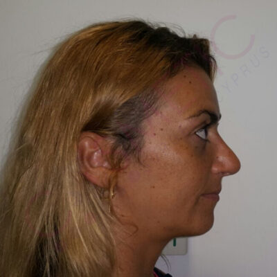 rhinoplasty nose job cosmetic surgery abroad