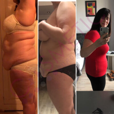 tummy tuck cosmetic surgery abroad