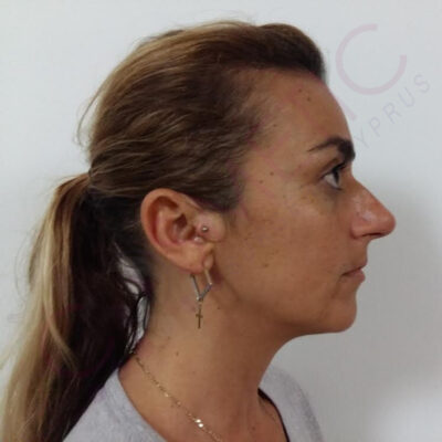 rhinoplasty nose job cosmetic surgery abroad