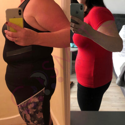 tummy tuck cosmetic surgery abroad