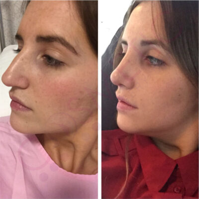 rhinoplasty nose job cosmetic surgery abroad