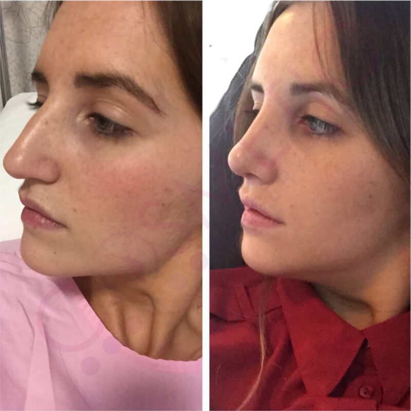 rhinoplasty nose job cosmetic surgery abroad