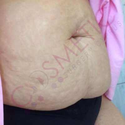tummy tuck cosmetic surgery abroad