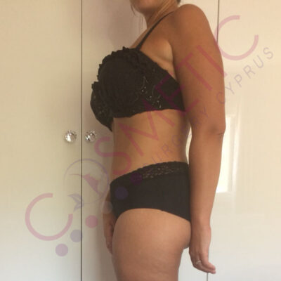 tummy tuck cosmetic surgery abroad