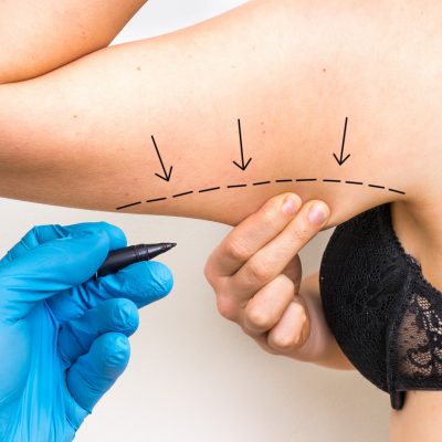 Plastic surgery doctor draw line on patient arm - cosmetic surgery abroad, arm lift brachioplasty