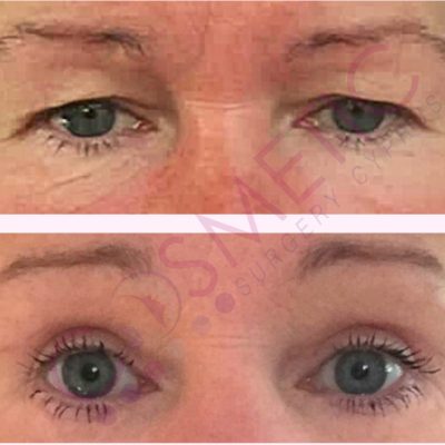 #blepharoplasty abroad Blepharoplasty Abroad