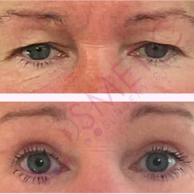 Blepharoplasty Abroad