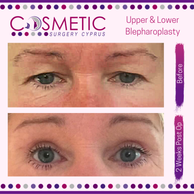 Blepharoplasty Abroad