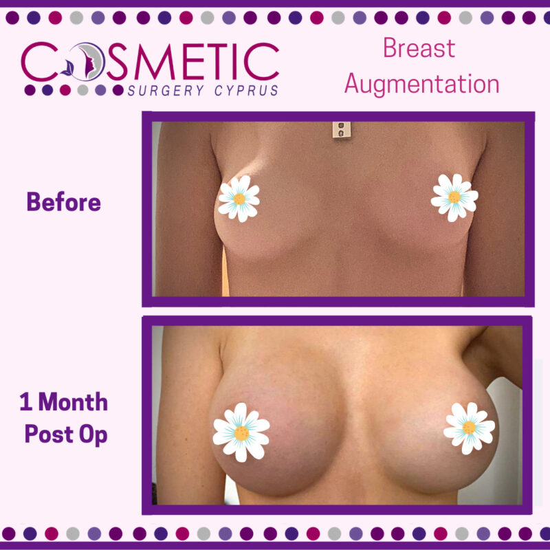 Breast Augmentation Cosmetic Surgery Cyprus