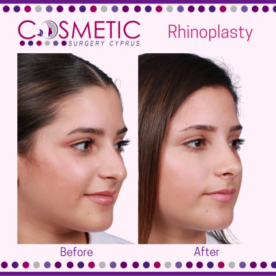 Ultrasonic Rhinoplasty