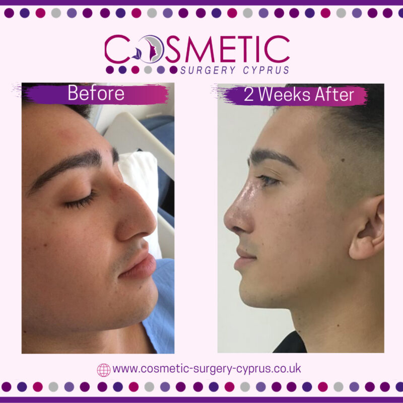Rhinoplasty Cosmetic Surgery