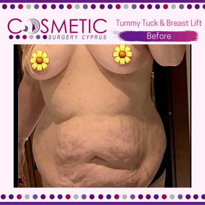 Breast Lift and Tummy Tuck