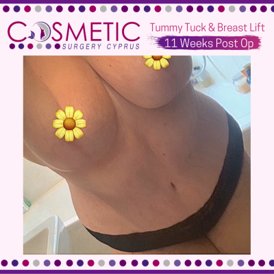 Breast Lift and Tummy Tuck After