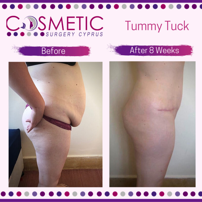 Tummy Tuck Cosmetic Surgery Cyprus