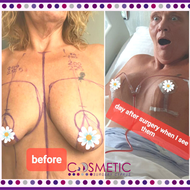 Breast Implants and Lift