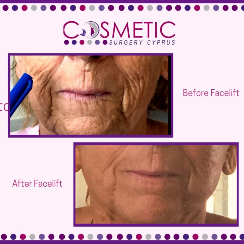 Facelift Cosmetic Surgery Cyprus