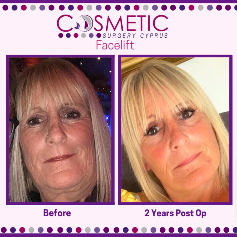 Facelift Cosmetic Surgery Cyprus