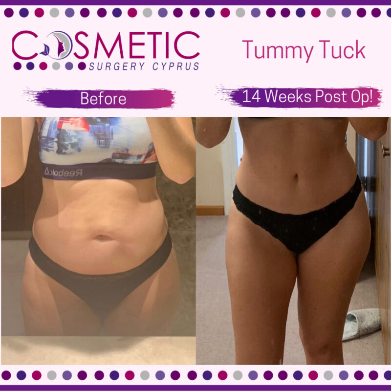 Tummy Tuck Cosmetic Surgery Cyprus