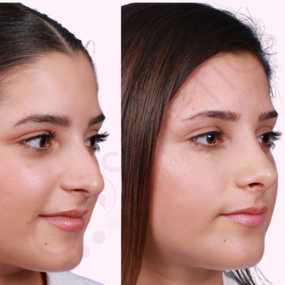 Ultrasonic Rhinoplasty 2