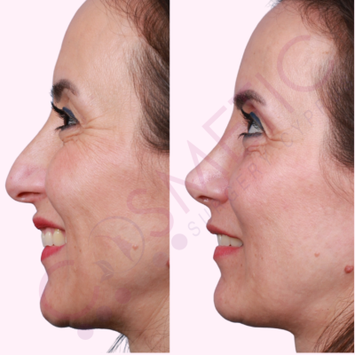 Ultrasonic Rhinoplasty