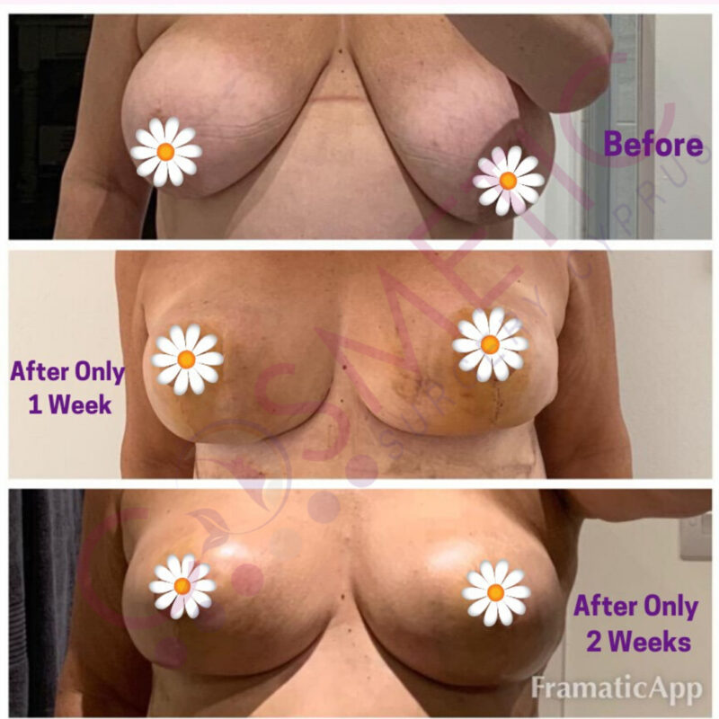 breast reduction cosmetic surgery cyprus