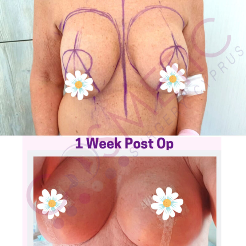 Breast Lift and Implant Cosmetic Surgery Abroad