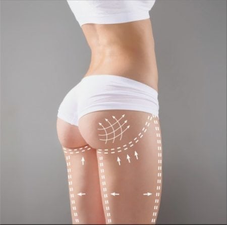 Fat Transfer to Buttocks (BBL) and Liposuction Gallery