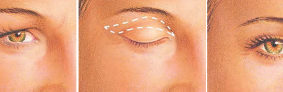 upper eyelid surgery in Cyprus