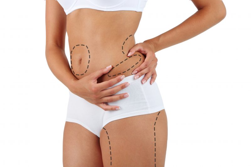 Liposuction - Cosmetic Surgery Abroad in Cyprus