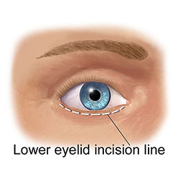 Lower eyelid surgery in Cyprus