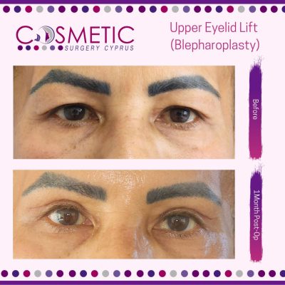 upper and lower blepharoplasty